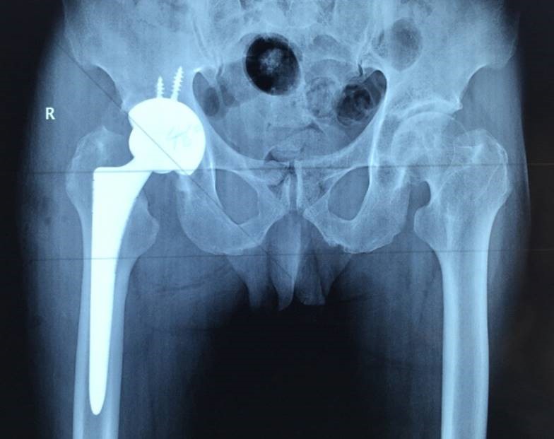 9.11髋关节2.jpg