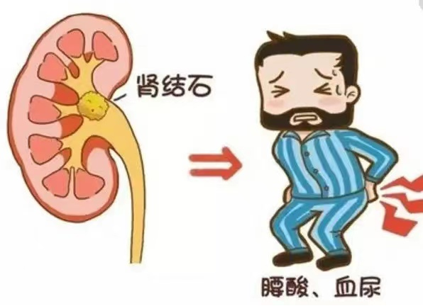 肾结石.png