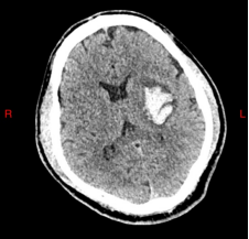 术前CT:清晰显示左侧基底节区20ml血肿