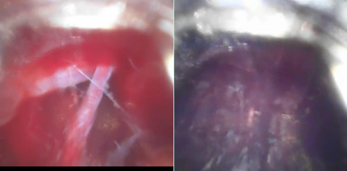 可视导管:镜下避开血管,直达血肿中心