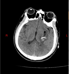 术后对比:血肿清除率达95%,脑组织压迫解除