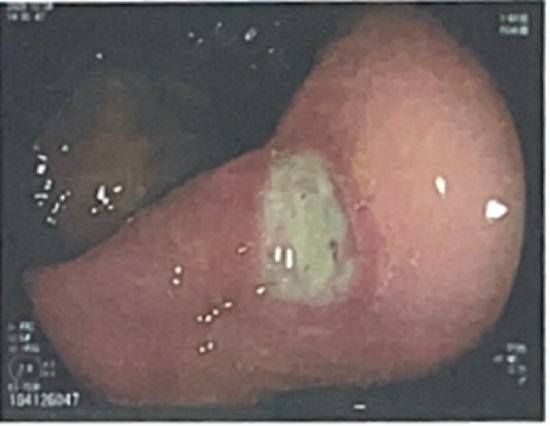 结石引发的溃疡