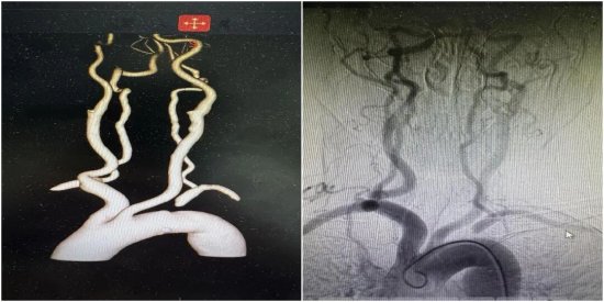 （头颈部血管CTA检查提示左侧锁骨下动脉起始段完全闭塞）
