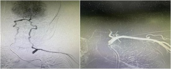 （介入手术中导管“双向”会师）